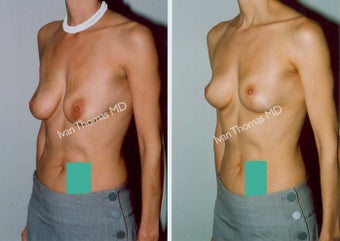 Mastopexy-Breast Lift before 243703