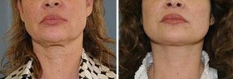 52 year old. Two month status post neck lift. before 343912