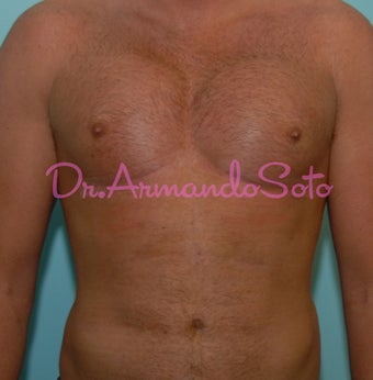 Pectoral Implants for Men after 564468