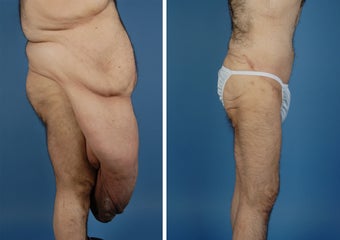 Body Lift 335979