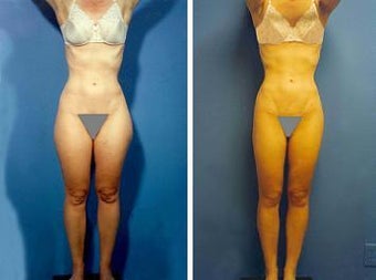 Liposuction before 636233