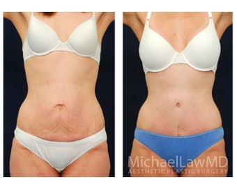 Abdominoplasty - Tummy Tuck before 396105