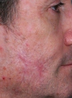 PDL scar treatment after 374580