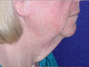 Necklift 208458