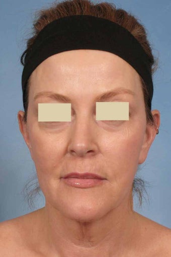 Phenol Peel after 125532