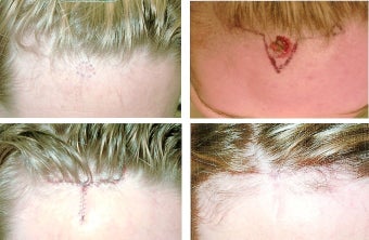 MOHS Skin Cancer Surgery before 369211