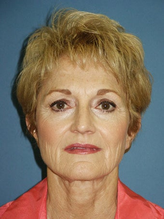 Chin augmentation with facial rejuvenation before 250159