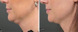 Ultherapy before 561798
