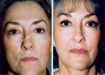 Non-Surgical Face Lift- Exoderm before 242994