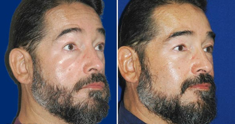 Sculptra after 496290