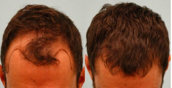 Hair Transplant before 133427