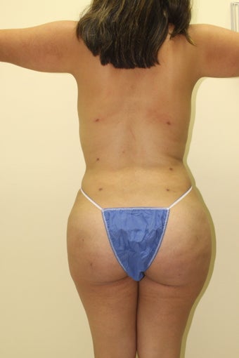 Brazilian butt lift 360623