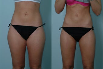 Smart Lipo before 369100