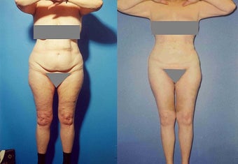 Liposuction before 636176