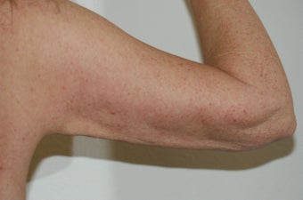 Arm lift (brachioplasty) 548317