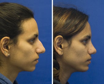 Chin Implantation with Rhinoplasty before 295372