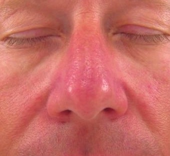 Vbeam for Rosacea Treatment after 374581