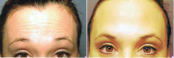 Botox before 575410
