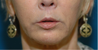 Lip lift + Chin implant + ArteFill after 522080