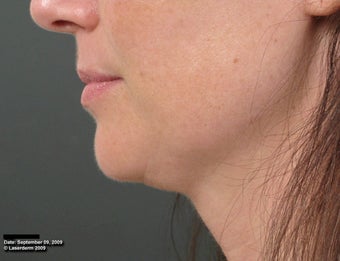 Ulthera Laser Skin Tightening after 346277