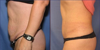 Mini Tummy Tuck after 98608