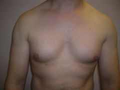 Pec Implants before 259002