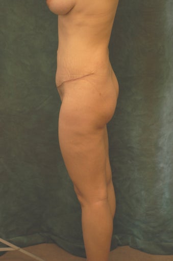 Women's Buttocks Augmentation before 518135