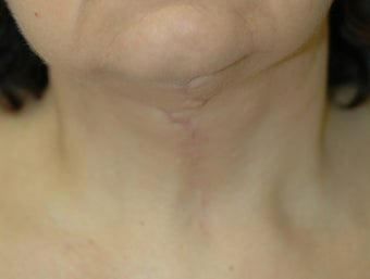 Neck Lift 542319