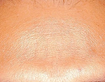 Laser tattoo removal after 374504