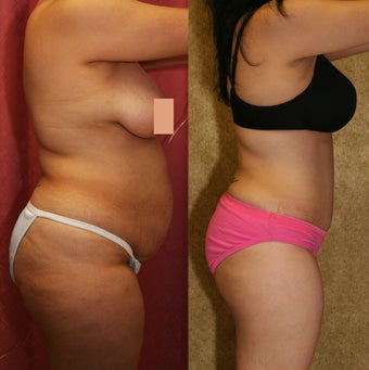 abdominoplasty- tummy tuck 468831