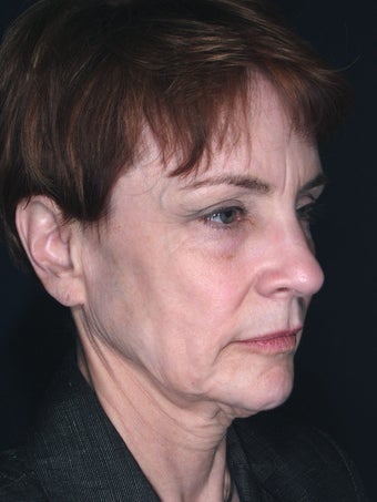 Vertical Facelift before 113262