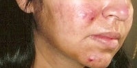 Acne Treatment with Smoothbeam before 271998