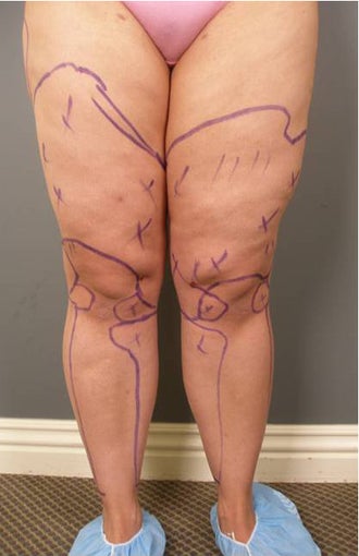 Tumescent Liposuction under local anesthesia. before 403765