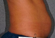 Liposonix 582710