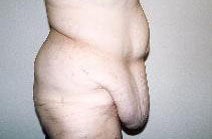 Body Contouring before 557014