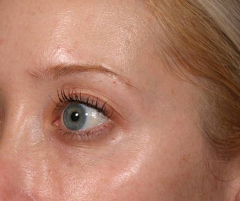 Restylane under eyes after 137841