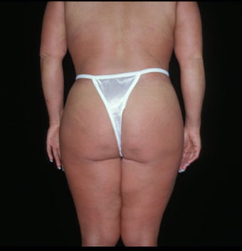 Lower Body Lift after 193547
