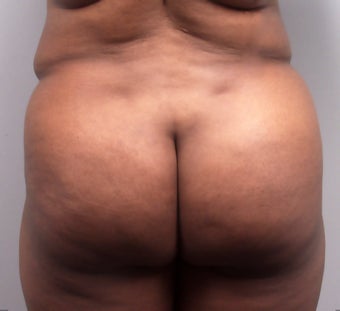 Butt Augmentation after 273288