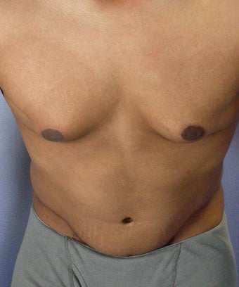 Male Body Contouring after 280188
