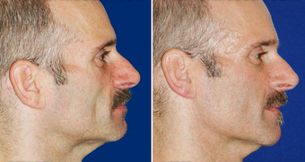 Sculptra after 496294