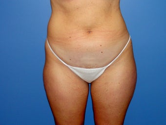 Tumescent liposuction before and after before 78800