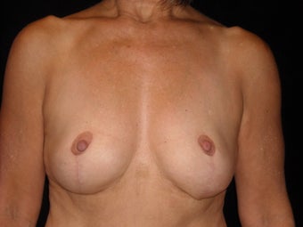 58 year old lady wanted implant removal and a breast lift after 631743