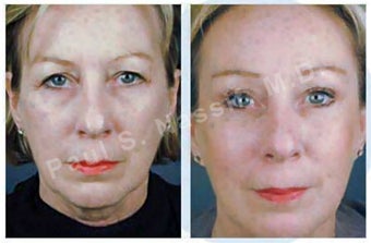 Complete Facial Rejuvenation before 138174