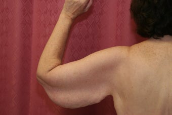 Brachioplasty or arm tuck in los angeles 583676