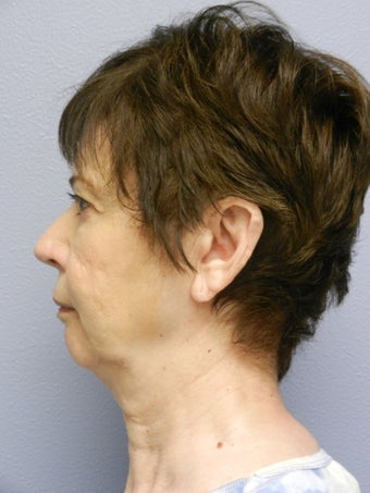 Lower Face Neck Lift 574541