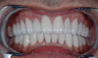 Smile Makeover with Porcelain Crowns after 382125