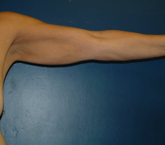 Brachioplasty before 576423