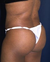 Brazilian Butt Lift (Butt Augmentation) after 242792