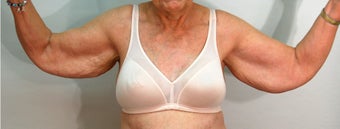 Brachioplasty before 524825
