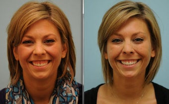 Gummy Smile Correction using Botox before 515452